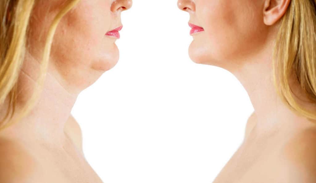Double Chin treatment Tamworth before and after results