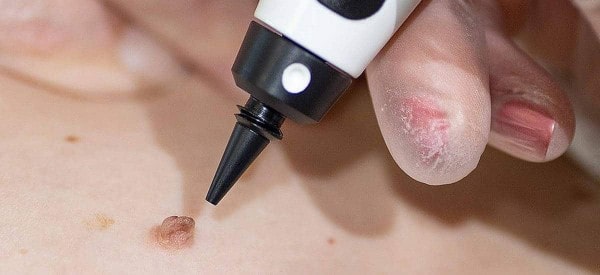 After Skin Tag Removal Tamworth