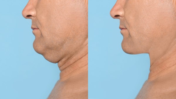 Which Non-Surgical Treatments Work Best for Jowls and Loose Skin Tamworth?