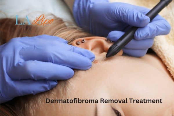 Dermatofibroma Removal Treatment Tamworth