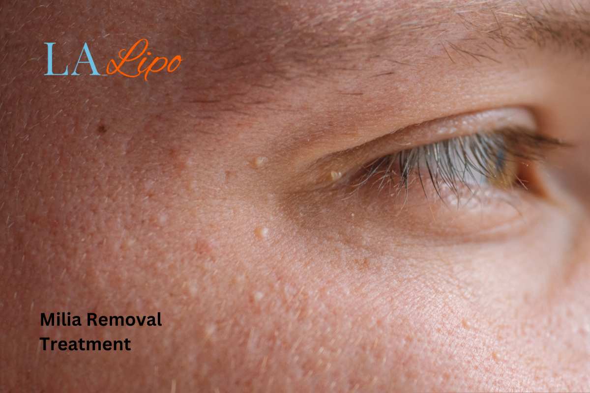Cryopen Milia Removal: Is It the Easiest and Safest Option Tamworth?