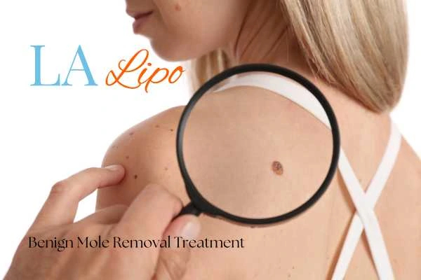 Woman having her inspection of blemish before mole removal Tamworth