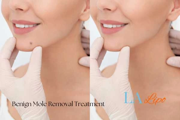 woman's before and after mole removal Tamworth results