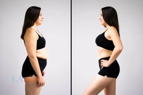 LA-EMS Body Sculpting Tamworth results before and after of womans results on body toning.
