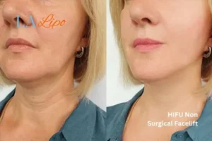 hi-fu for wrinkles Tamworth before and after results