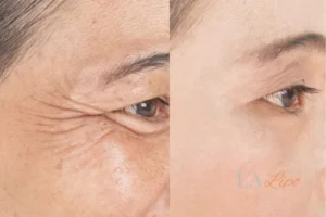 Before and after results of woman - HI-fu wrinkles reduction treatment Tamworth