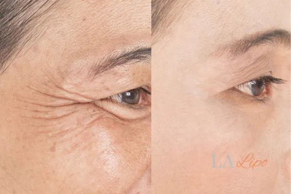 Before and after results of woman - HI-fu wrinkles reduction treatment Tamworth