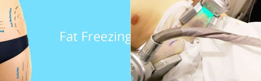Fat freezing Tamworth on multiple areas of the body