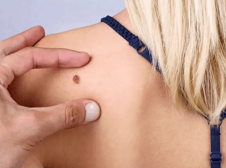 woman having mole removal Tamworth consultation before treatment.