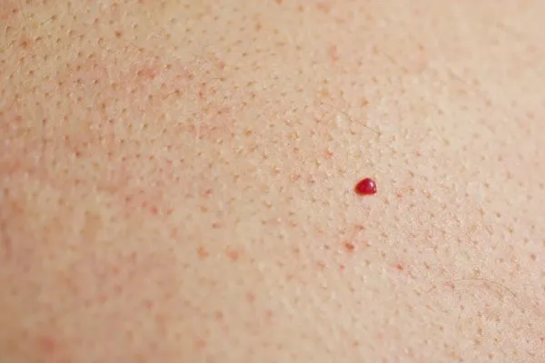 close up of a cherry angioma Tamworth