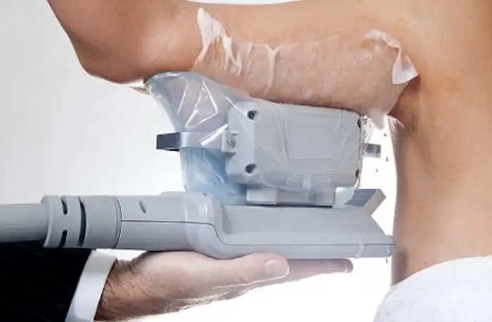 Picture of fat freezing Tamworth on the upper arms.