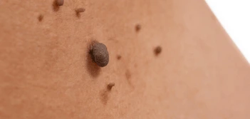 image of a skin tag Tamworth