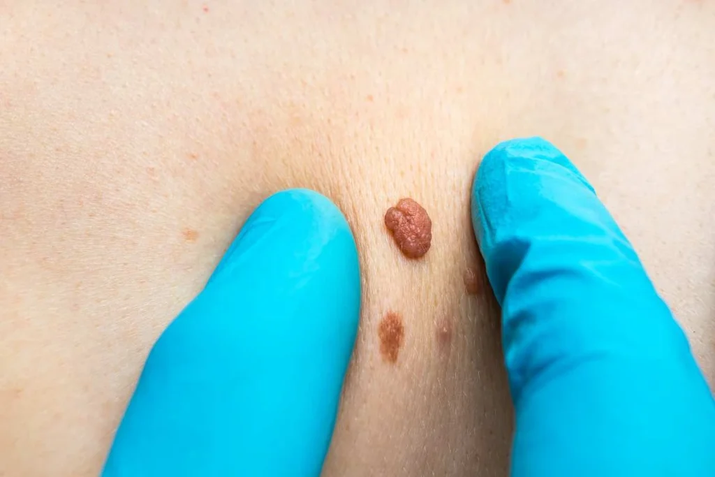 Consultant examining a skin tag Tamworth