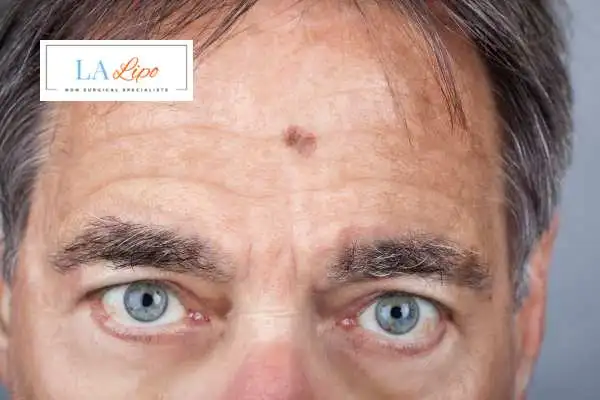 Solar Lentigo Removal Tamworth image of man with mark on his forehead