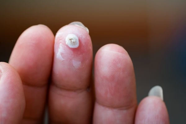 wart on person finger - cryotherapy to treat from LA LIPO Tamworth
