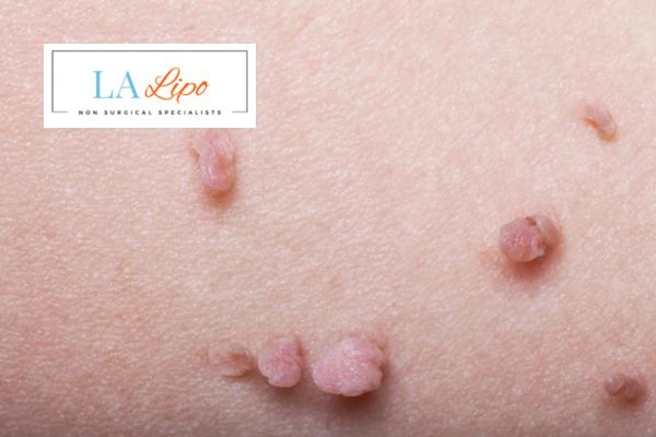 Does cryopen skin tag removal Tamworth hurt? Find out now call our team today!