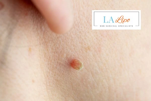 Book skin tag removal Tamworth today speak to our team now!