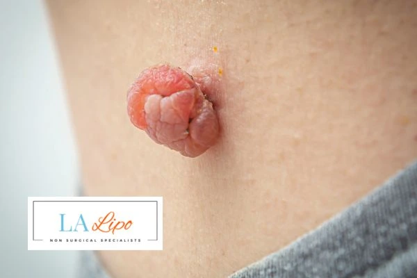 Interested in skin tag removal Tamworth? Concerned about the pain? Find out more today!