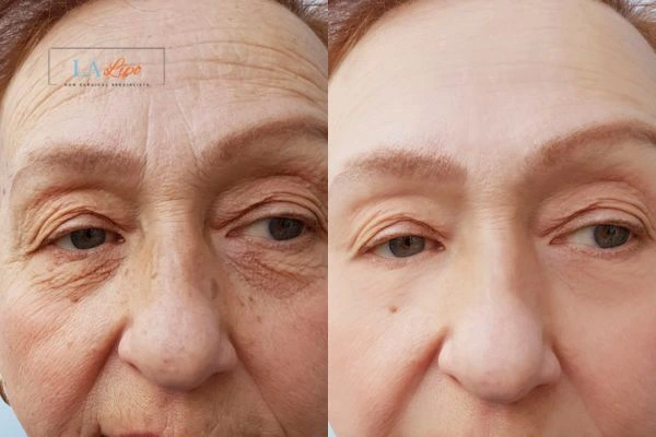 The powerful benefits of Morpheus8 Treatment Tamworth - Call Our team today!