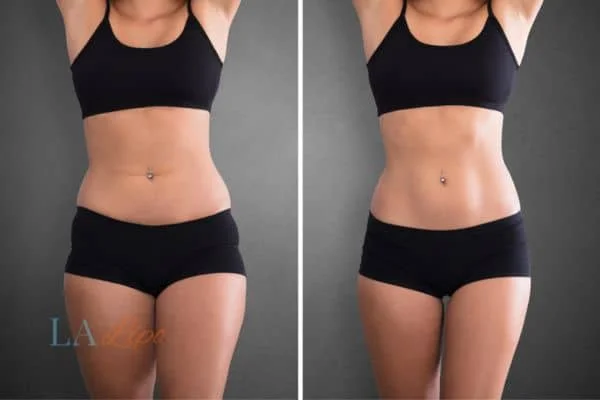 before and after results of non-surgical treatment to help a woman's body image and mental health Tamworth