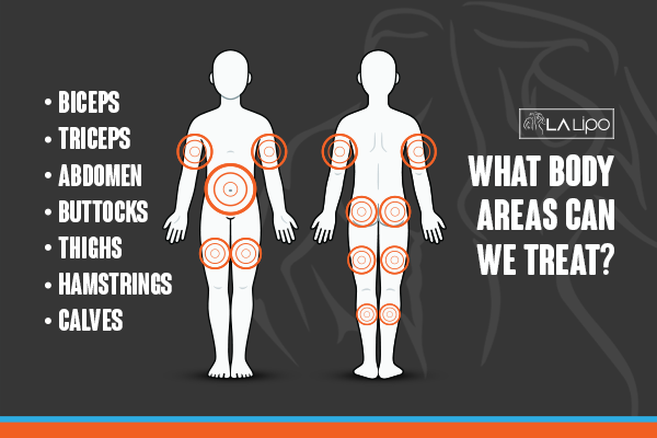 Diagram to show areas you can have LA-EMS Body Sculpting Treatment Tamworth