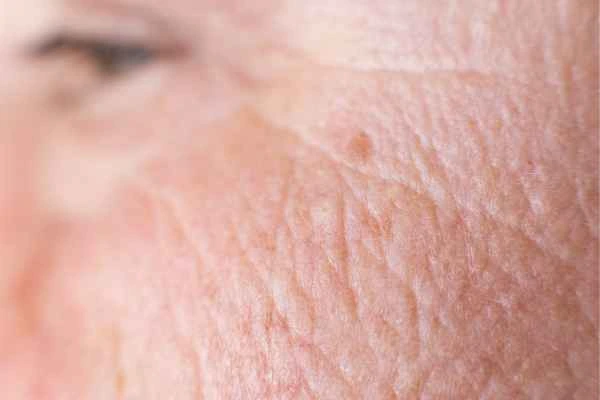 close up picture of a woman's face showing an age spot Tamworth