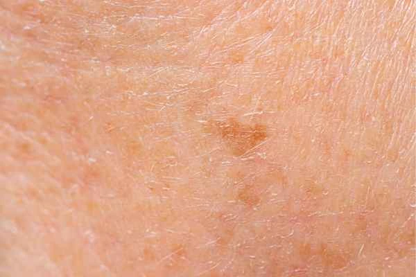 close up picture of age spots Tamworth
