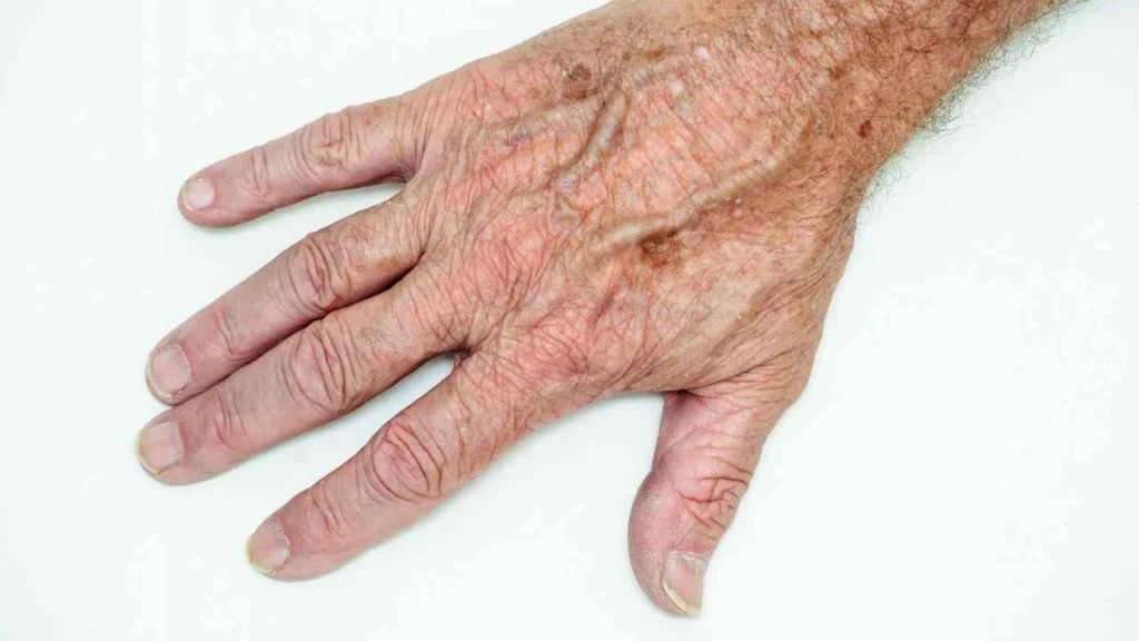 Male hand showing age spot Tamworth