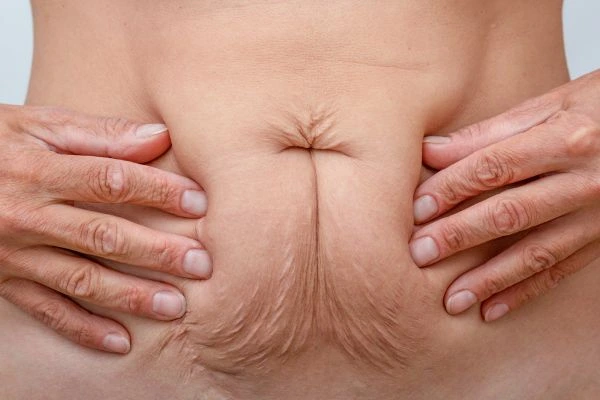 Should I Combine Diastasis Recti Treatment with Body Contouring for Better Results Tamworth?