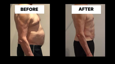 What Symptoms Can Diastasis Recti Cause in Men? Weak Core, Back Pain and Poor Posture Tamworth